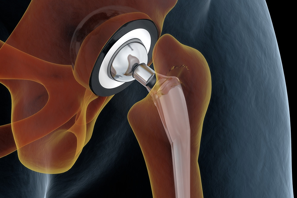 5 Key Signs It’s Time To Consider a Hip Replacement