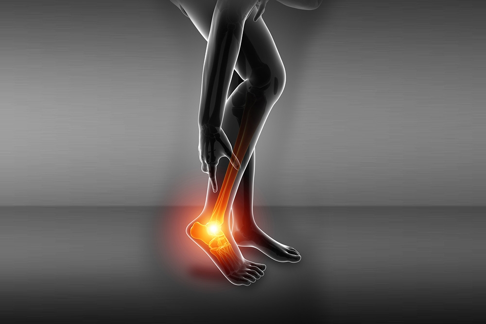 Ankle Fracture: Definition, Anatomy, and Causes