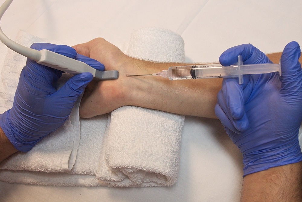 Exploring Carpal Tunnel Injections: A Nonsurgical Solution for Relief