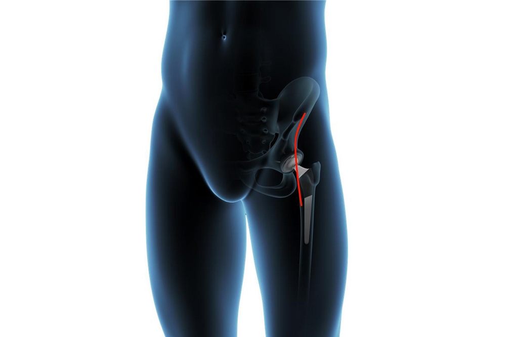Exploring the Benefits of Anterior Hip Replacement Surgery