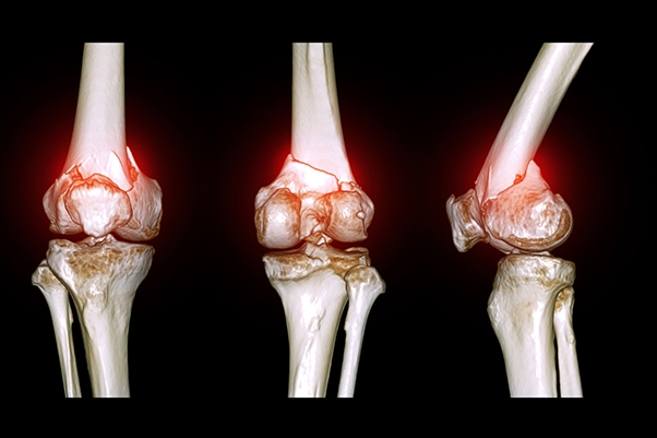 How Robotic Knee Replacement Works: From CT Scan to Surgery Day
