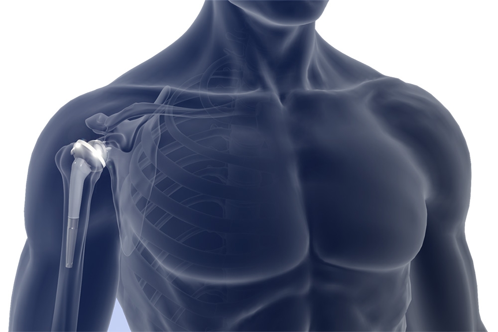 Reverse Shoulder Replacement: Your Top Questions Answered