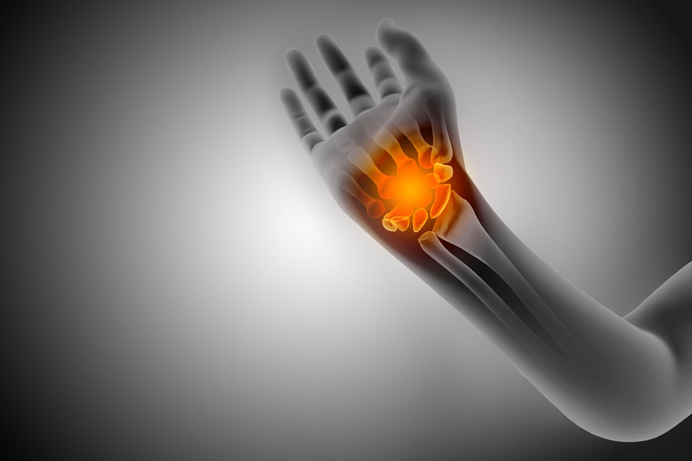 Understanding Carpal Tunnel Syndrome Symptoms