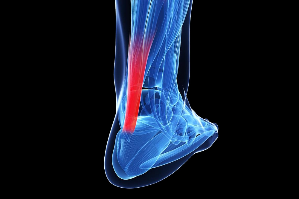 When a Split Second Sidelines a Season: Understanding and Recovering From Achilles Tendon Ruptures