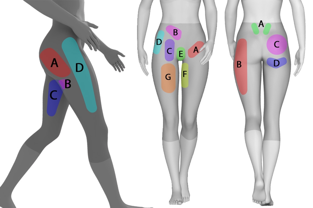 Where Does It Hurt? Use Our Hip Pain Location Diagram