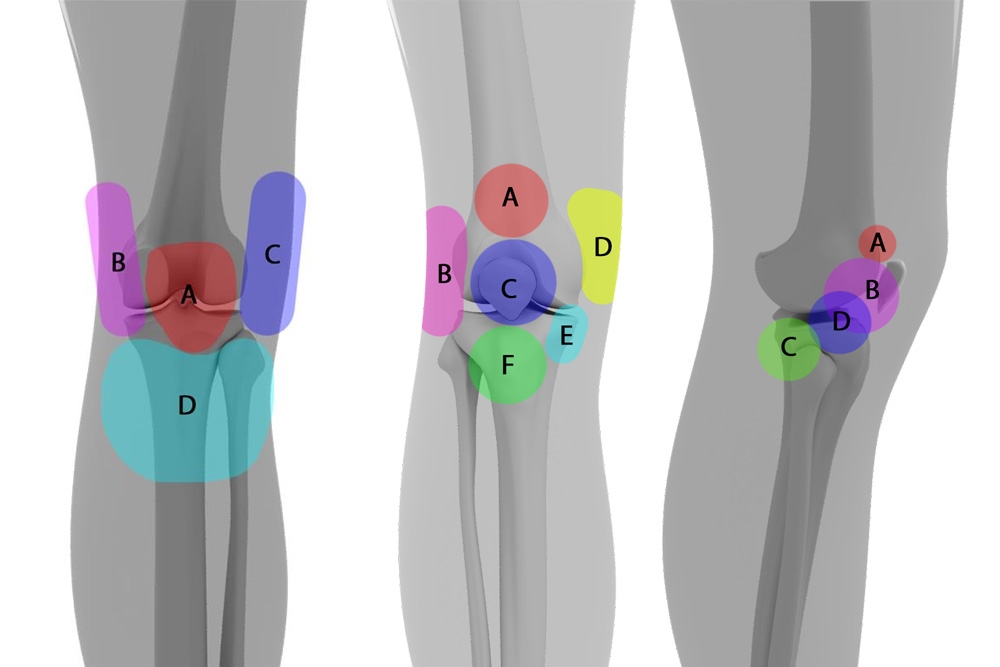 Where Does it Hurt? Use This Knee Pain Location Chart