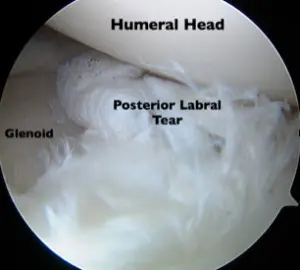 Labral shoulder tear debridement shown via a camera with the humeral head, glenoid, and posterior labral tear labeled. 