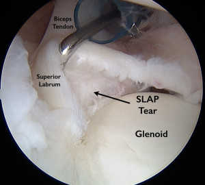 Arthroscopic image of a superior labral (SLAP) tear shoulder injury. 