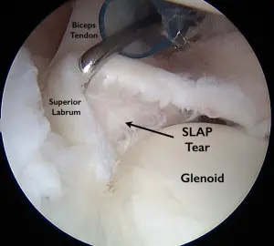 Superior labral (SLAP) tear repair shown via camera with the glenoid, SLAP tear, superior labrum, and biceps tendon labeled. 