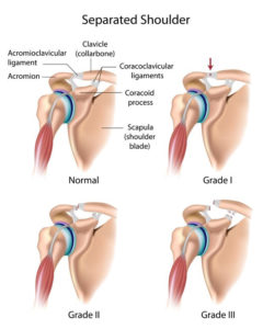  An illustration of the shoulder joint and a separated shoulder injury.