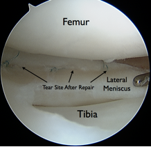 Photo of the femur, tibia, lateral meniscus, and the tear site after repair.