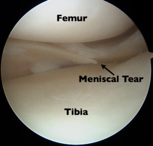  Photo of the femur, tibia, and a meniscus tear. 