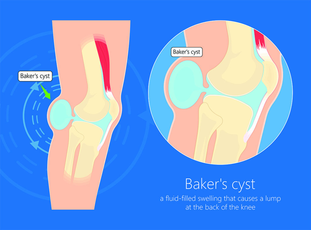 Medical illustration of the formation of a Baker’s cyst at the back of the knee