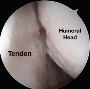 After Remplissage Procedure – Tendon attached to Hill Sachs Lesion
