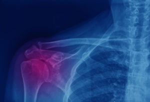 X-ray with focus on right rotator cuff shoulder pain.