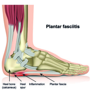  A medical illustration of the bones and tendons of the human foot, with arrows identifying the heel bone, heel spur, an area of inflammation, and the plantar fascia.