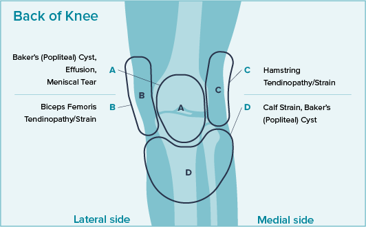 Knee pain location chart showing pain in the back of the knee from Baker’s (Popliteal) Cyst, Effusion, Biceps Femoris Tendinopathy/Strain, Hamstring Tendinopathy/Strain, and Calf Strain, Baker’s (Popliteal) Cyst.