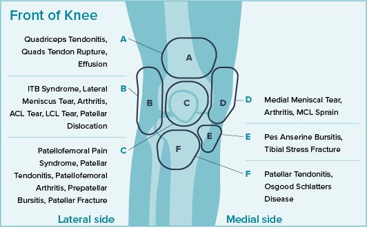 Knee pain chart showing front of the knee and Quadriceps Tendonitis, Quads Tendon Rupture, Effusion, ITB Syndrome, Lateral Meniscus Tear, Arthritis, ACL Tear, LCL Tear, Patellar Dislocation, Patellofemoral Pain Syndrome, Patellar Tendonitis, Patellofemoral Arthritis, Prepatellar Bursitis, Patellar Fracture, Medial Meniscal Tear, Arthritis, MCL Sprain, Pes Anserine Bursitis, Tibial Stress Fracture, and Patellar Tendonitis, Osgood-Schlatter Disease.