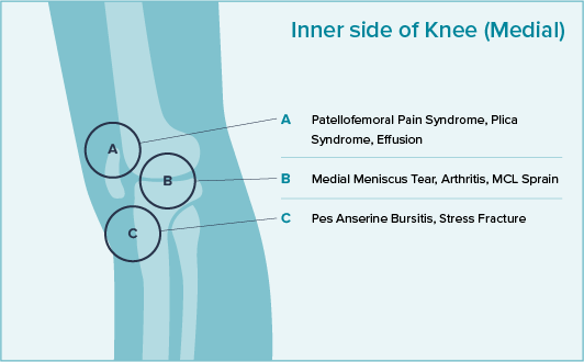 Inner knee pain location chart that shows the Patellofemoral Pain Syndrome, Plica Syndrome, Effusion, Medial Meniscus Tear, Arthritis, MCL Sprain, and Pes Anserine Bursitis, Stress Fracture.