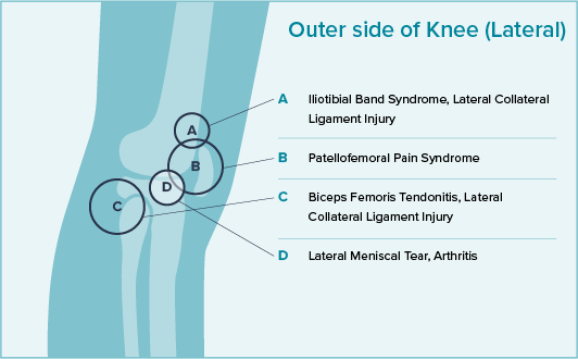 A knee pain diagram of the outer side of the knee displaying the Iliotibial Band Syndrome, Lateral Collateral Ligament Injury, Patellofemoral Pain Syndrome, Biceps Femoris Tendonitis, Lateral Collateral Ligament Injury, and Lateral Meniscal Tear, Arthritis.